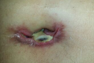 What to Expect Before, During, and After Hernia Surgery