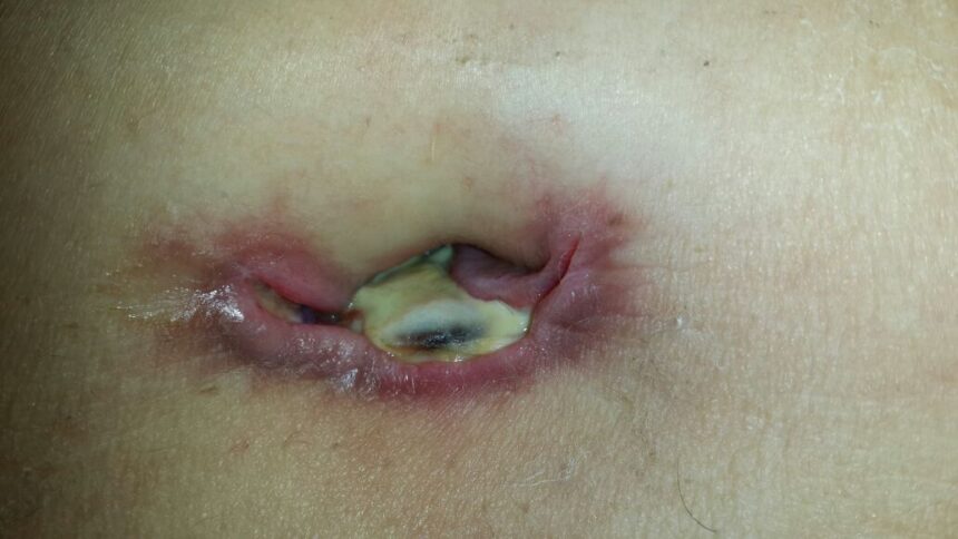 What to Expect Before, During, and After Hernia Surgery
