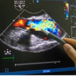 What to Expect During an Echocardiogram