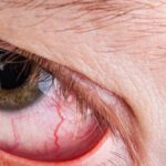 What to expect with Retinal Detachment Recovery