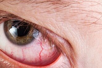 What to expect with Retinal Detachment Recovery