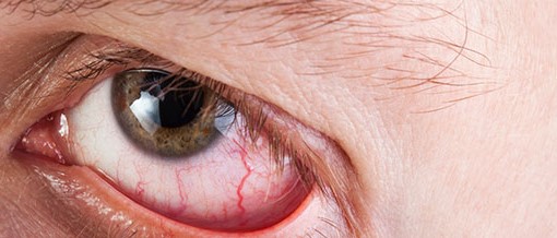 What to expect with Retinal Detachment Recovery