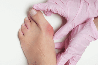 When To Seek Treatment for Bunions