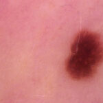 Why Dermatologists Are at the Forefront of Skin Cancer Detection
