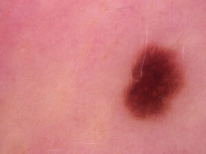 Why Dermatologists Are at the Forefront of Skin Cancer Detection