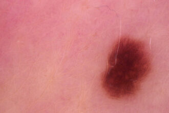 Why Dermatologists Are at the Forefront of Skin Cancer Detection
