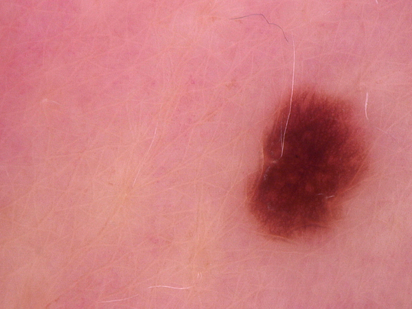 Why Dermatologists Are at the Forefront of Skin Cancer Detection