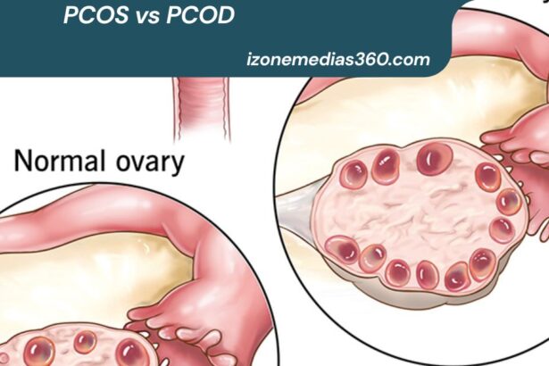 PCOS vs PCOD