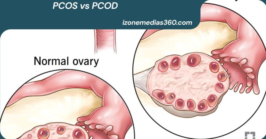 PCOS vs PCOD